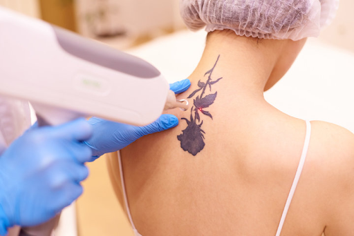 Laser Tattoo Removal