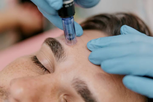 Microneedling for skin rejuvenation